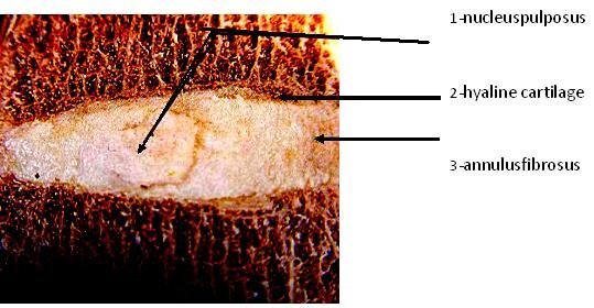 herniated disc diagram, endoscopic disc surgery
