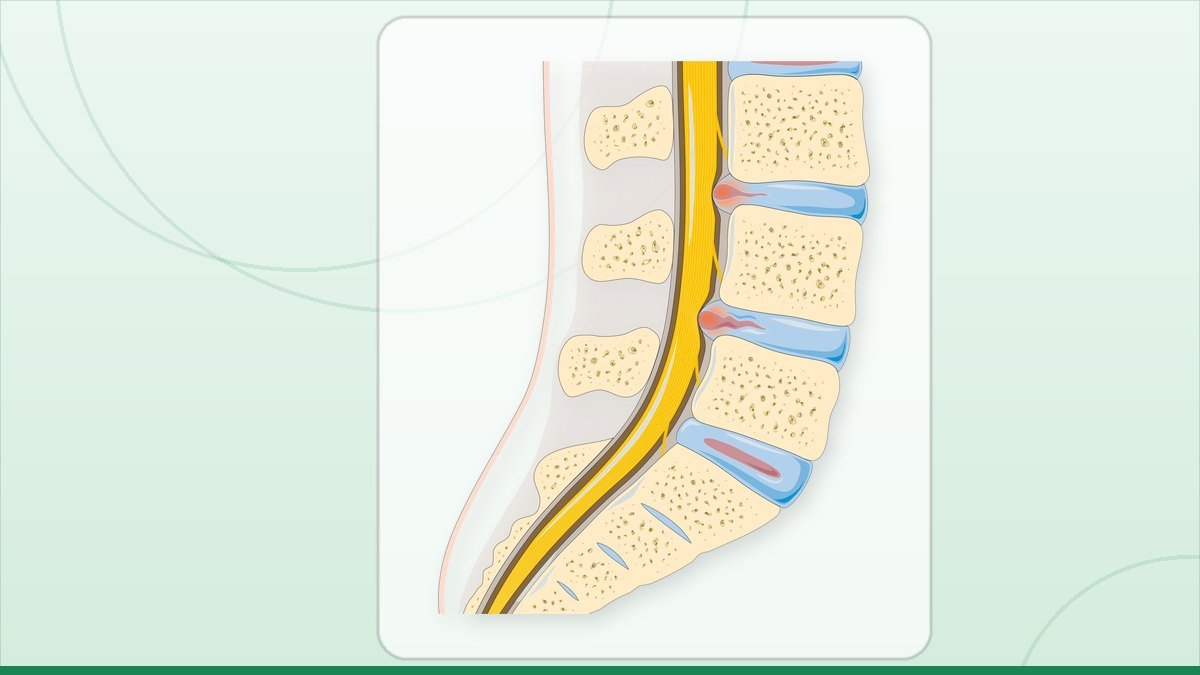 medical illustration: disc herniation