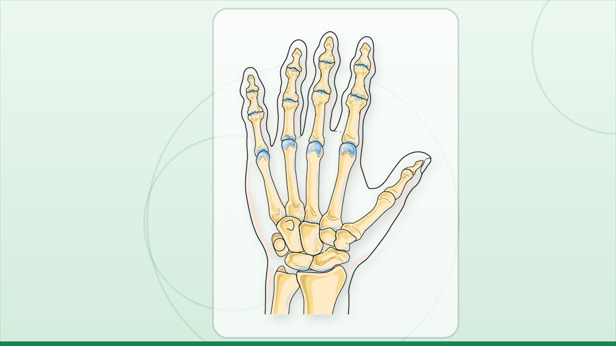 medical illustration: rheumatology - Osteoarthritis