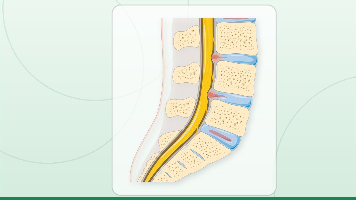 medical illustration: disc herniation