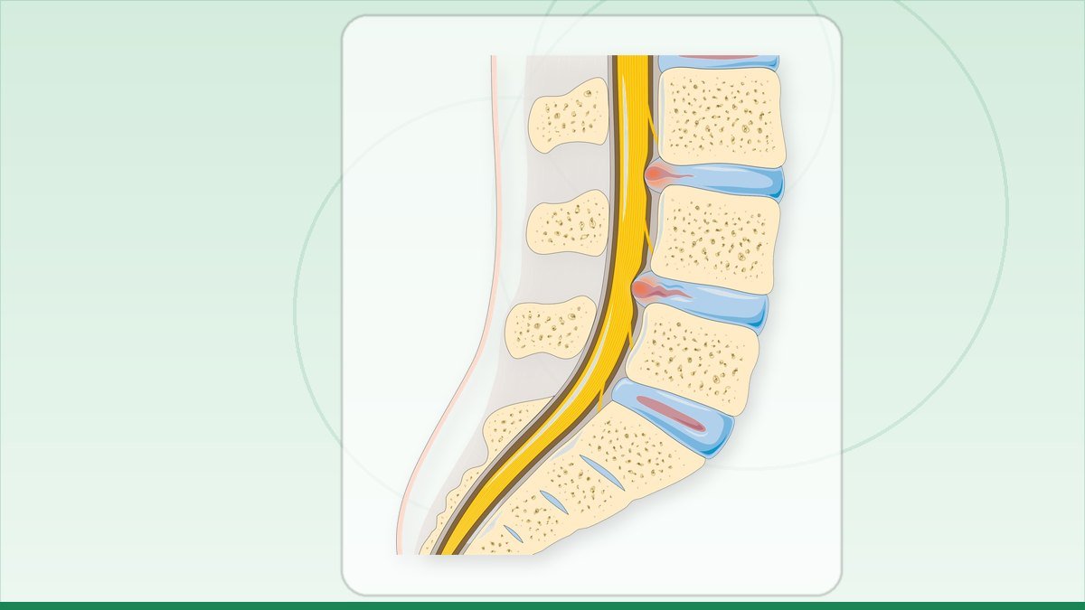 medical illustration: disc herniation