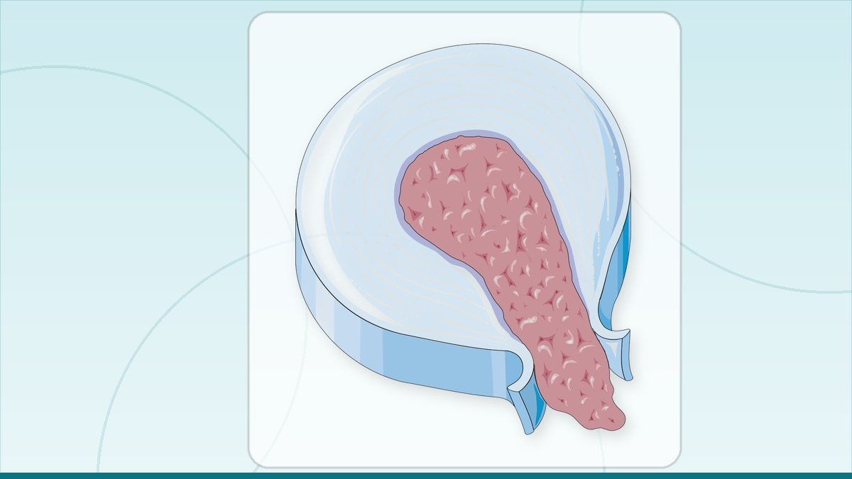 medical illustration: disc herniation - Extrusion