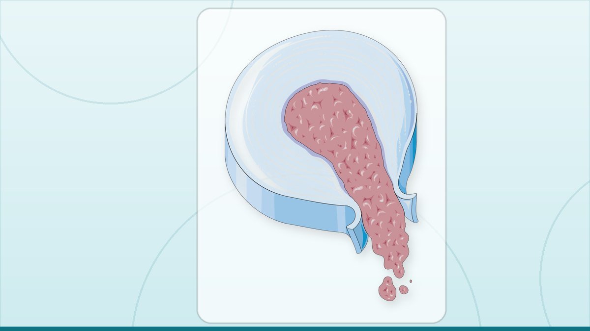 medical illustration: disc herniation - Sequestration