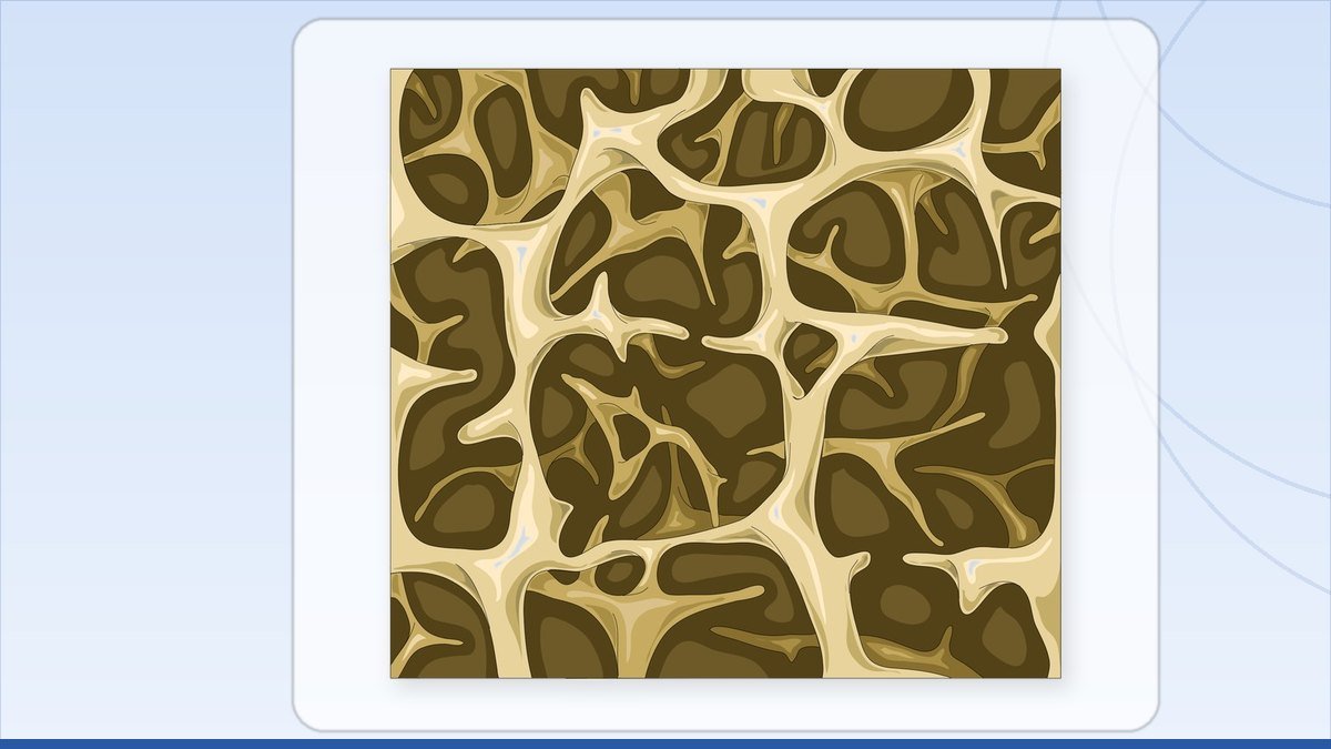 medical illustration of osteoporotic trabecular (spongy) bone structure