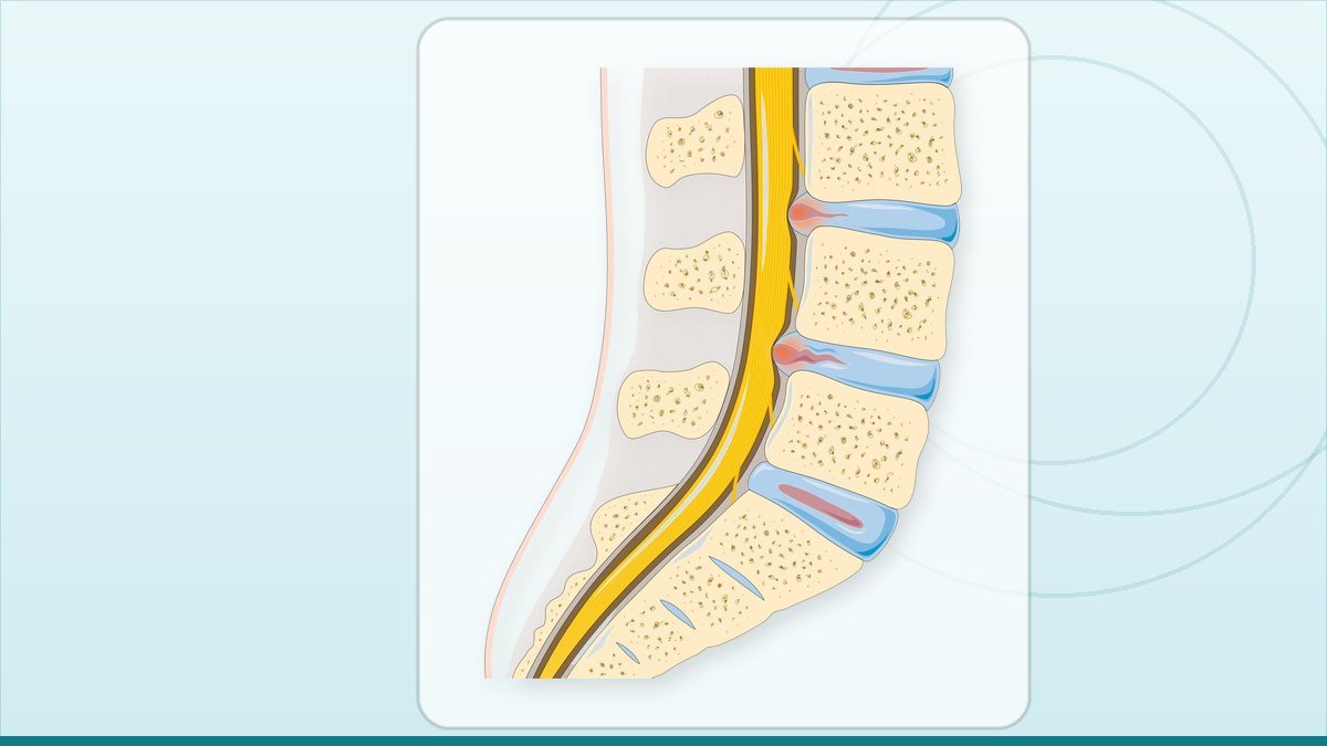 medical illustration: disc herniation