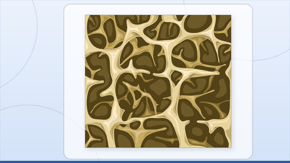 medical illustration: spongy bone - Trabecular bone - Osteoporotic trabecular bone