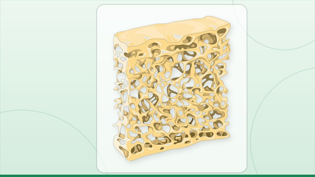 medical illustration: rheumatology - Osteoporotic bone