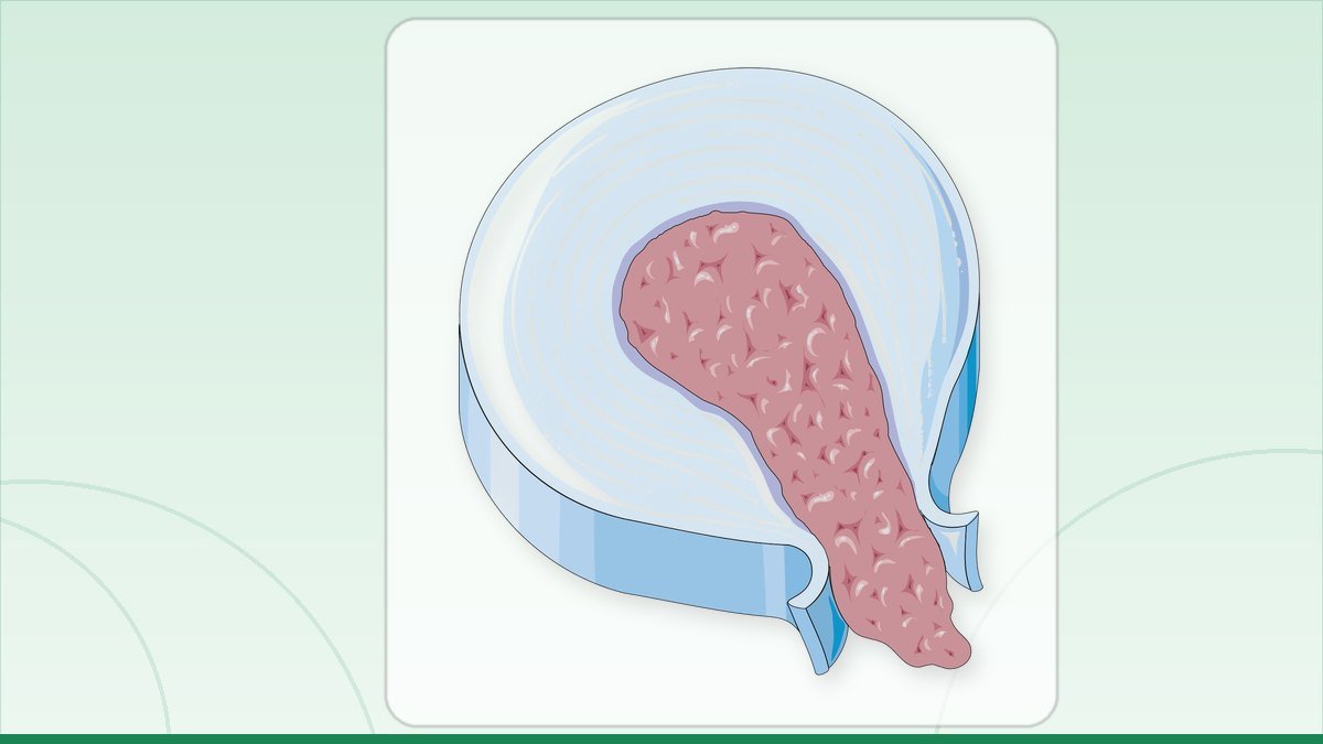 medical illustration: disc herniation - Extrusion