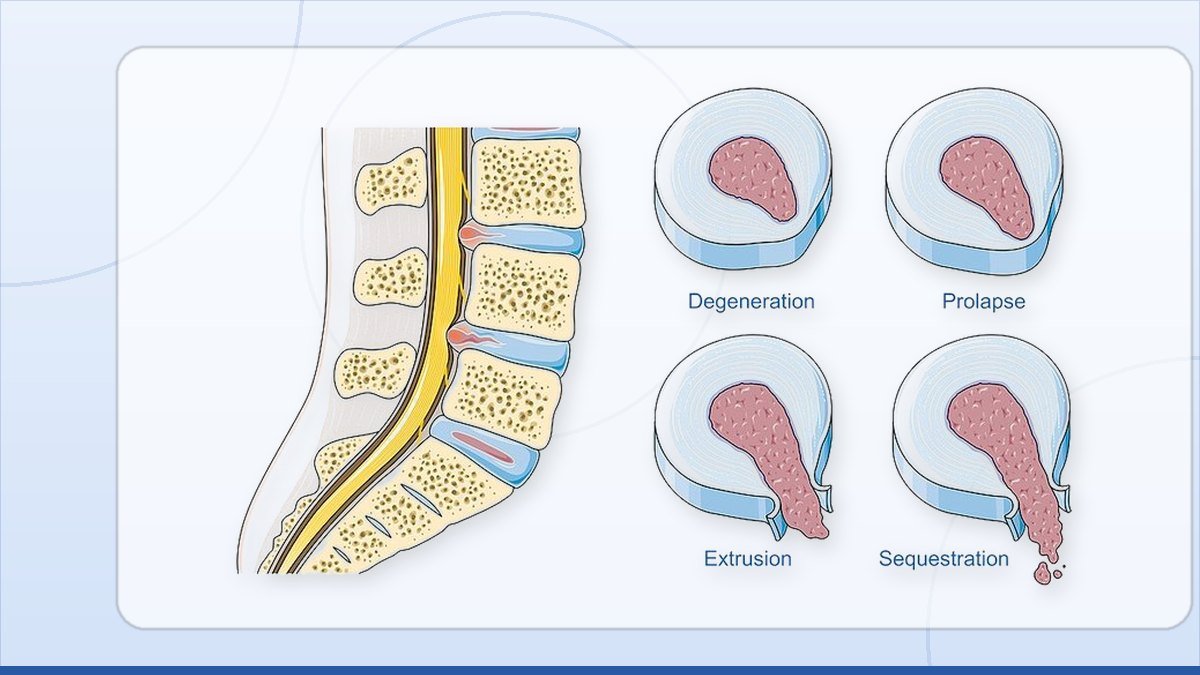 medical illustration: disc herniation - Degeneration Prolapse Extrusion Sequestration