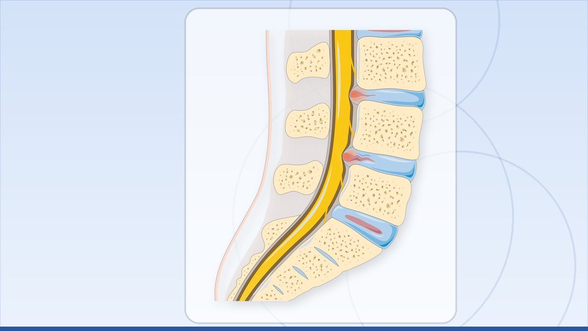 medical illustration: disc herniation