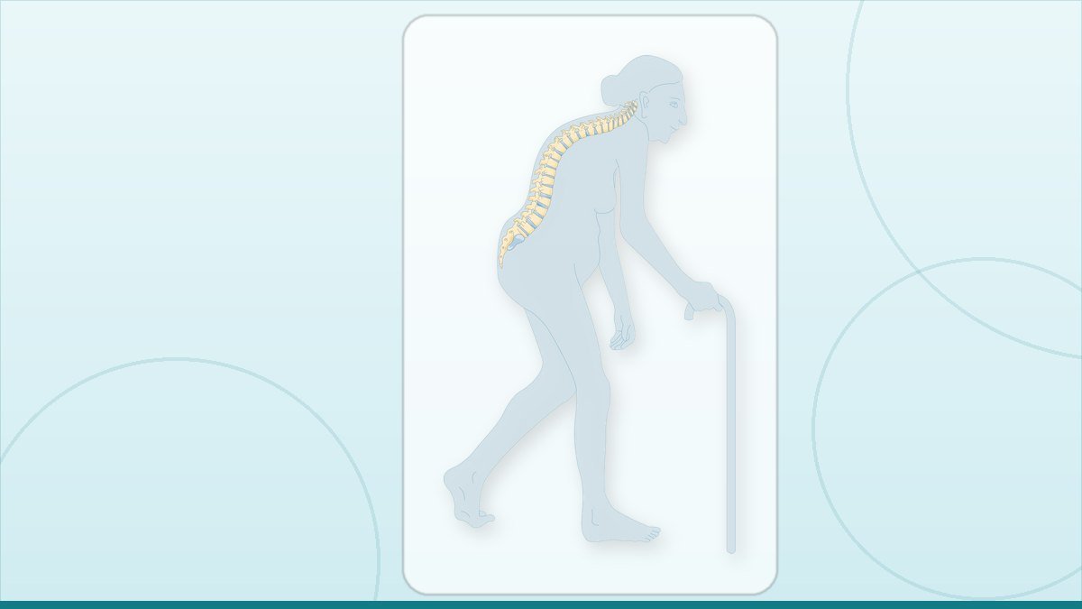 medical illustration: severe osteoporosis