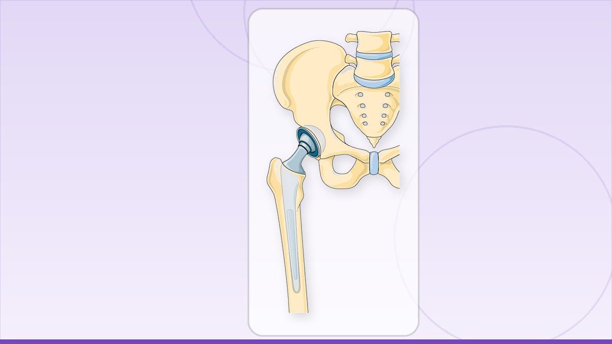 medical illustration: rheumatology - Total hip replacement