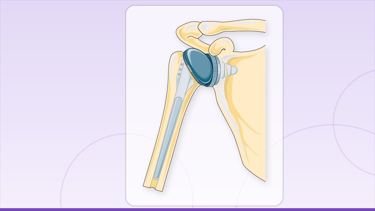 medical illustration: rheumatology - Shoulder replacement