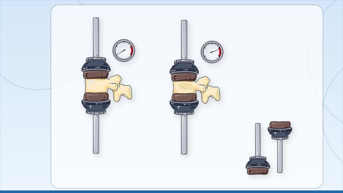 medical illustration: vertebra compression test
