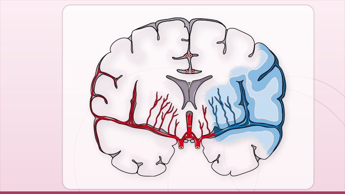 medical illustration: ischemic Stroke