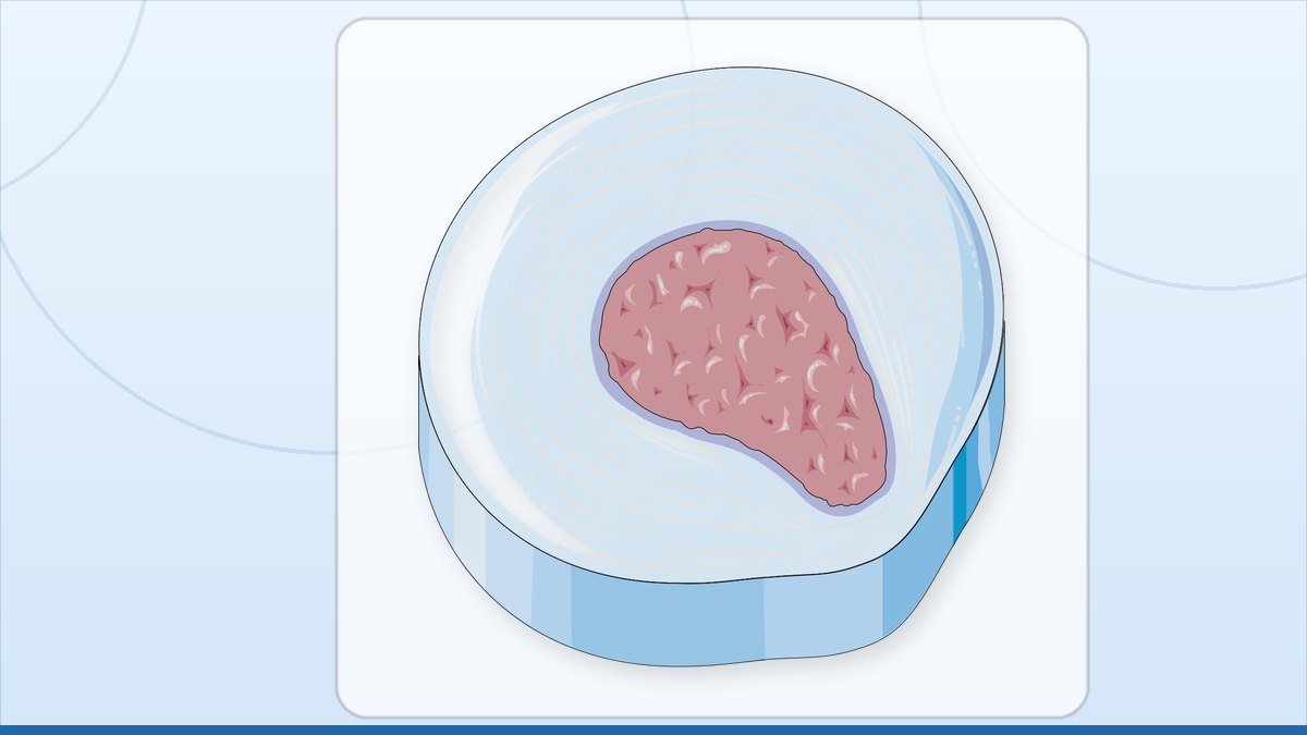 medical illustration: disc herniation - Degeneration