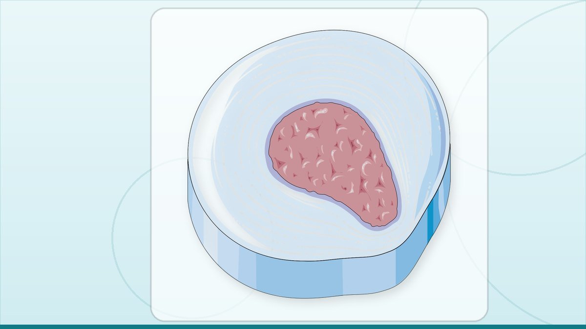 medical illustration: disc herniation - Degeneration