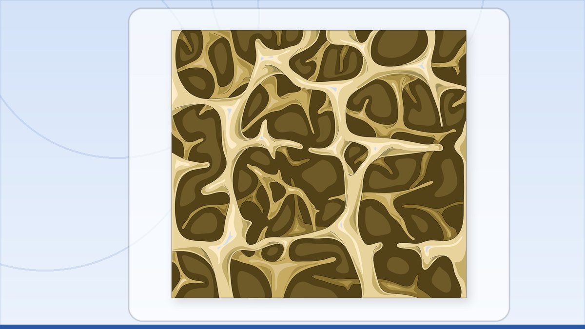 medical illustration: spongy bone - Trabecular bone - Osteoporotic trabecular bone
