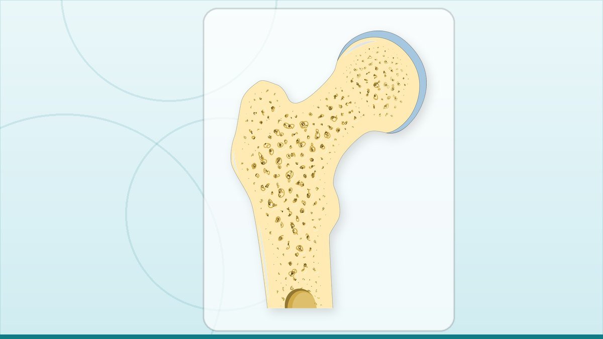 medical illustration: osteoporosis